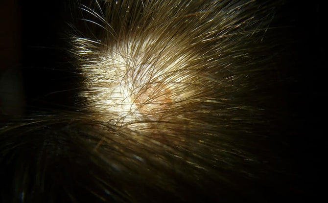 Lichen ruber mit Haarausfall: Welche Behandlung ist möglich?