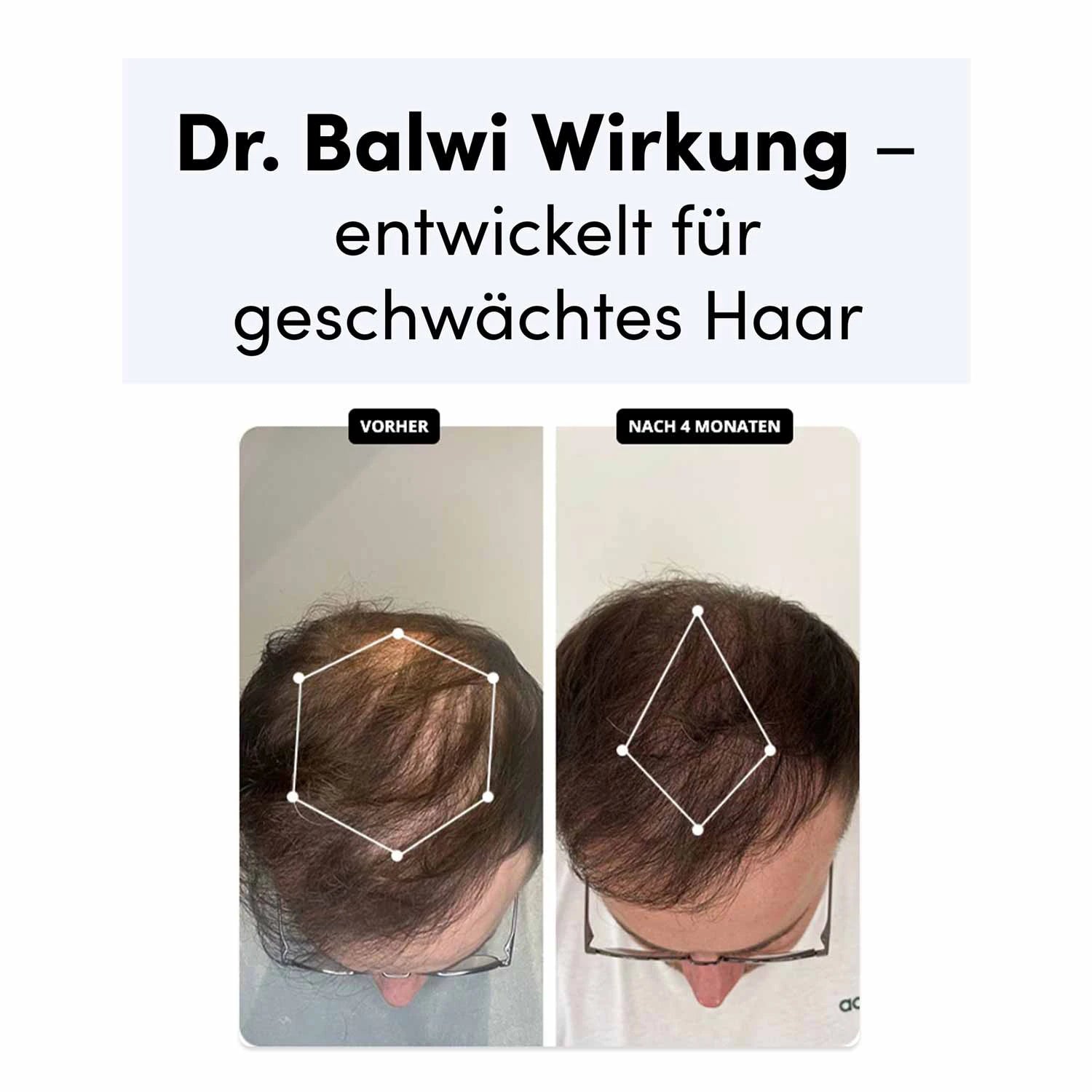 Die Kopfhaut eines Mannes vor und nach viermonatiger Anwendung von Dr. Balwi Shampoo von shop.elithairtransplant zeigt sichtbares Haarwachstum und verbesserte Haardichte. Die deutsche Beschreibung erklärt, wie Dr. Balwi Shampoo geschwächtes Haar unterstützt.