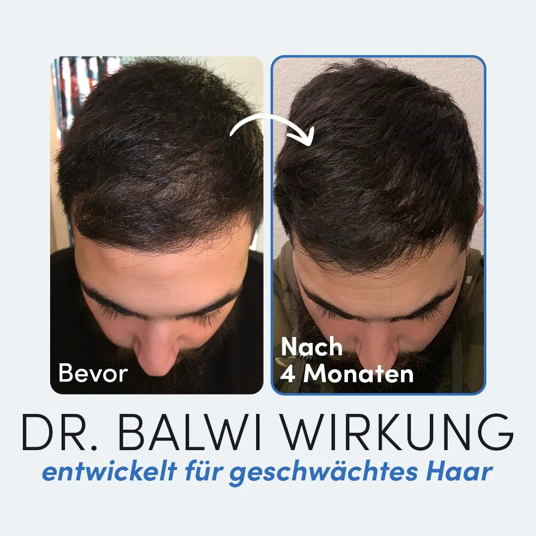 Zwei nebeneinander liegende Fotos zeigen den Oberkopf eines Mannes vor und nach 4 Monaten. Das linke zeigt schütteres Haar, das rechte volleres Haar - ein Ergebnis, das zeigt, wie Dr. Balwi Meso Therapie von Dr. Balwi Shop Haarwachstum unterstützen kann.