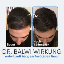 Zwei nebeneinander liegende Fotos zeigen den Oberkopf eines Mannes: links (Bevor) mit schütterem Haar, rechts (Nach 4 Monaten) mit vollerem Haar - Dr. Balwi Meso Therapie (Refill) aus dem Dr. Balwi Shop hilft, Haarwachstum sichtbar zu fördern.