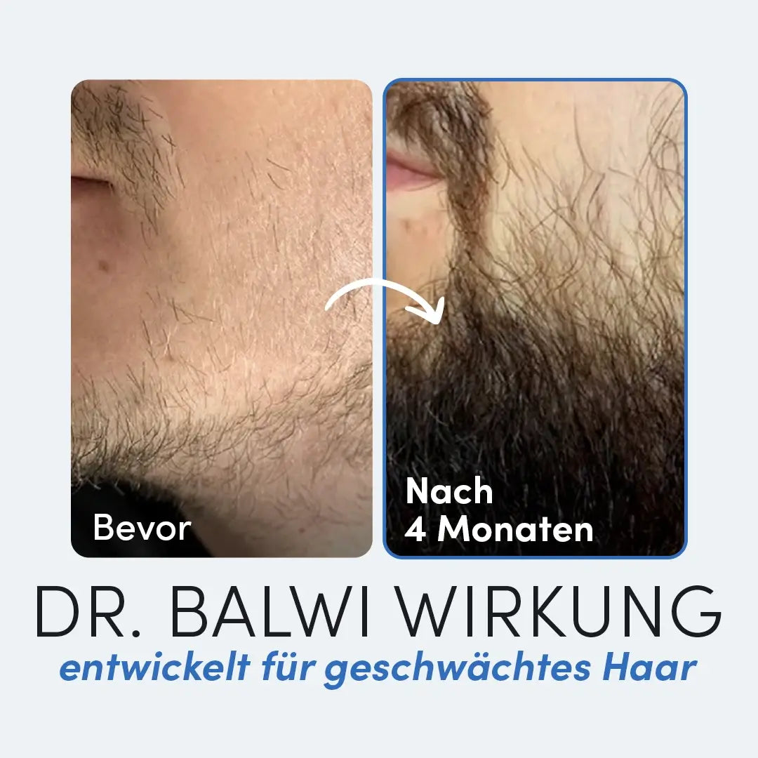 Nebeneinander liegende Nahaufnahmen der Kieferpartie eines Mannes: links spärliche Gesichtsbehaarung mit der Aufschrift "Vorher", rechts dichter Bartwuchs mit der Aufschrift "Nach 4 Monaten". Unten: Dr. Balwi Beard Serum von Dr. Balwi Shop, entwickelt, um schwaches Haar zu stärken.
