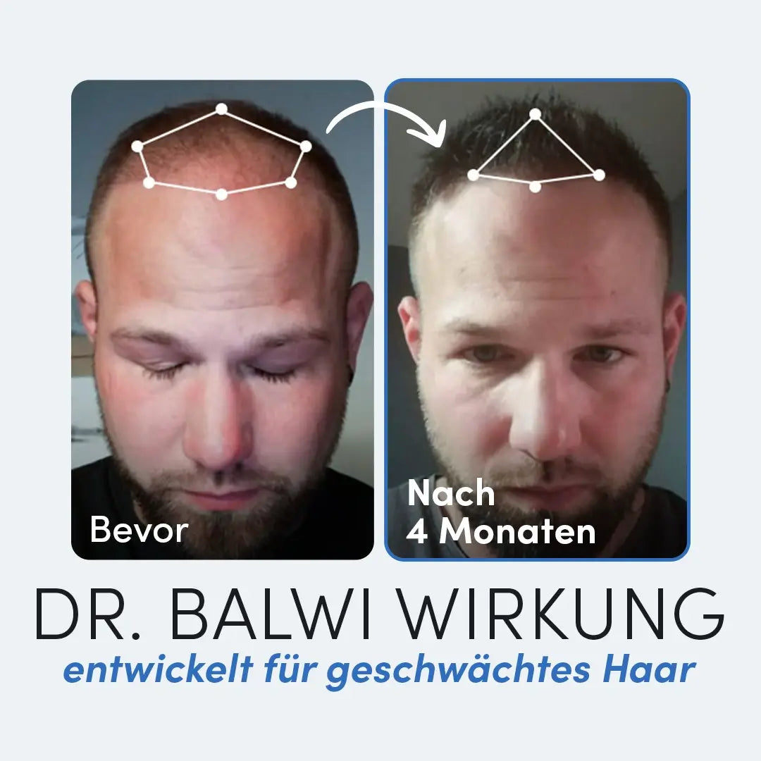 Nebeneinander stehende Fotos zeigen das Haarwachstum eines Mannes: links (Bevor) ist sein Haar schütter, rechts (Nach 4 Monaten) ist es sichtbar voller. Text: DR. BALWI WIRKUNG mit Biotin & Keratin Tabletten von Dr. Balwi Shop für geschwächtes Haar.