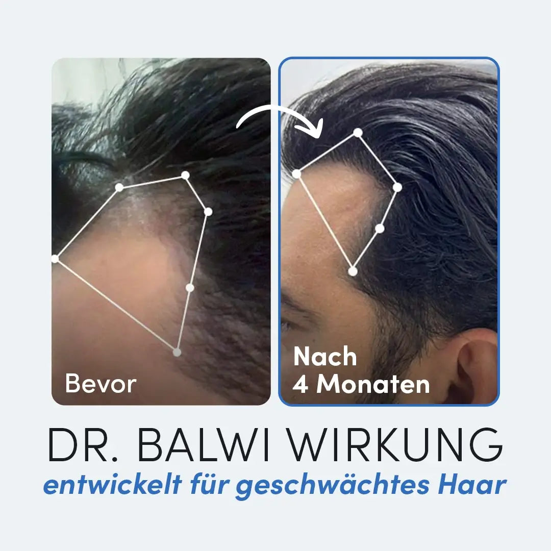 Vorher-nachher Vergleich eines Mannes nach 4 Monaten mit Bromelain von Dr. Balwi Shop: links weniger Haare, rechts sichtbar vollere Haarlinie. Text ist auf Deutsch.