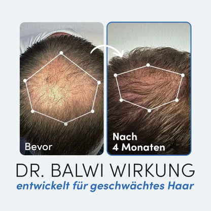 Nebeneinanderstehende Fotos zeigen den Fortschritt des Haarwachstums: links (Bevor) mit schütterem Haar, rechts (Nach 4 Monaten) mit vollerem Haar. Die Ergebnisse wurden mit dem Dr. Balwi Dermaroller aus dem Dr. Balwi Shop erzielt; Microneedling Haare fördert das sichtbare Wachstum.