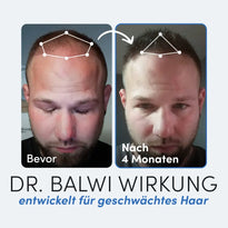 Nebeneinander liegende Fotos des Kopfes eines Mannes vor und nach der Anwendung der Dr. Balwi Massagebürste aus dem Dr. Balwi Shop; links zeigt dünner werdendes Haar mit der Aufschrift Vorher, rechts volleres Haar nach 4 Monaten mit der Aufschrift Nach 4 Monaten.