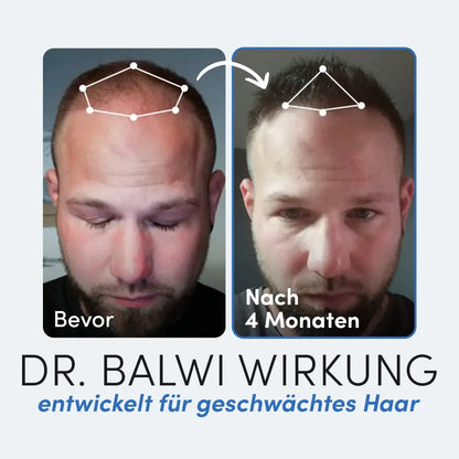 Nebeneinander liegende Fotos des Kopfes eines Mannes vor und nach der Anwendung der Dr. Balwi Massagebürste aus dem Dr. Balwi Shop; links zeigt dünner werdendes Haar mit der Aufschrift Vorher, rechts volleres Haar nach 4 Monaten mit der Aufschrift Nach 4 Monaten.