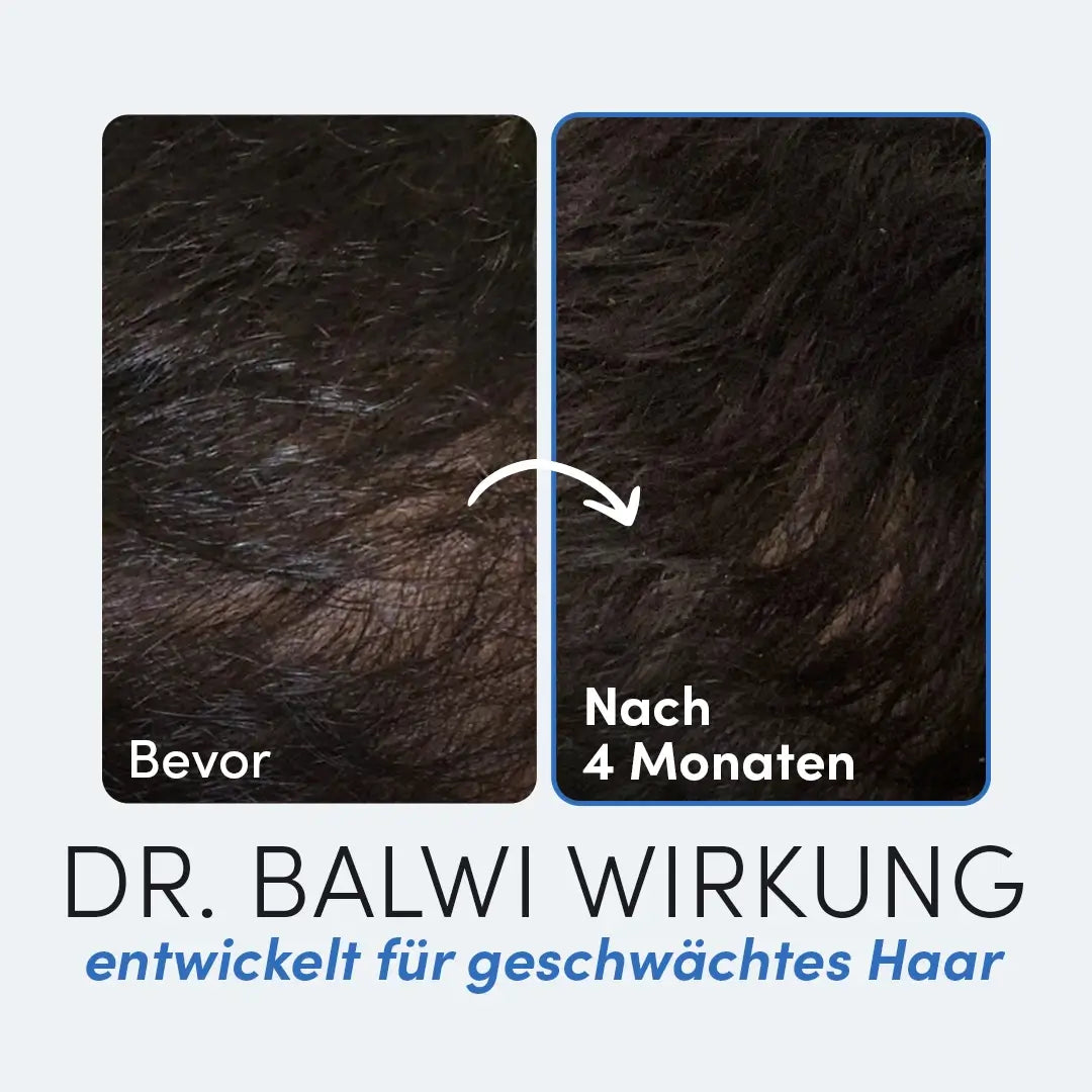 Der nebeneinander liegende Vergleich der Kopfhaut, beschriftet mit Vorher und Nach 4 Monaten, zeigt ein sichtbar dichteres Haarwachstum nach der Anwendung von Daily Omega 3 by Dr. Balwi Shop, entwickelt zur Unterstützung von geschwächtem Haar.