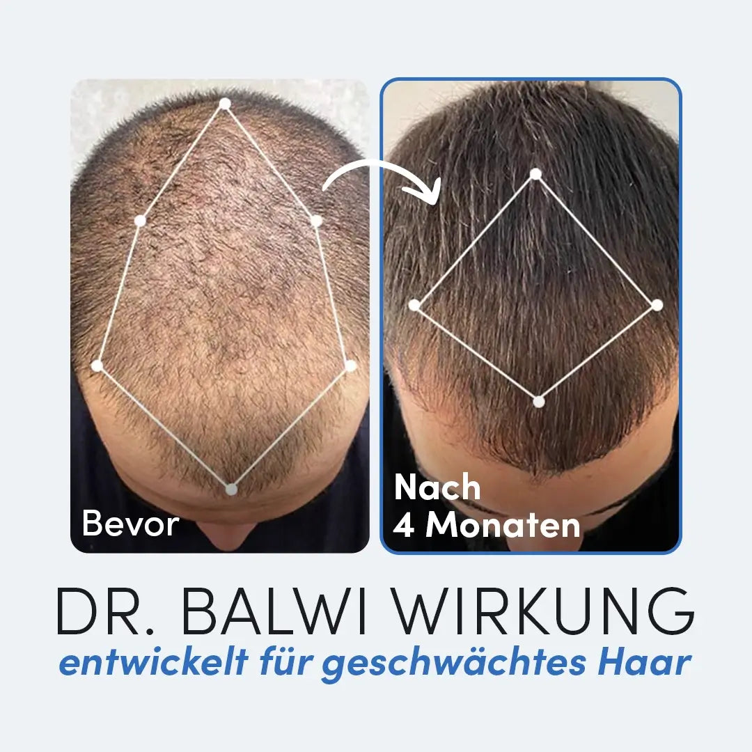 Vergleich der Kopfhaut eines Mannes vor und nach der Haarausfall Behandlung: links (Bevor) zeigt dünner werdendes Haar, rechts (Nach 4 Monaten) zeigt volleres Haar. Unten wird das Dr. Balwi Shop Shampoo & Spray Set für eine effektive Haartransplantation Nachsorge vorgestellt.