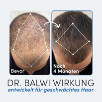 Vergleich der Kopfhaut eines Mannes vor und nach der Haarausfall Behandlung: links (Bevor) zeigt dünner werdendes Haar, rechts (Nach 4 Monaten) zeigt volleres Haar. Unten wird das Dr. Balwi Shop Shampoo & Spray Set für eine effektive Haartransplantation Nachsorge vorgestellt.